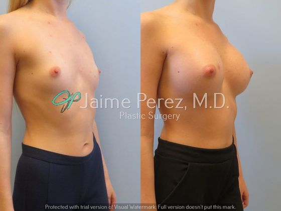 Breast Augmentation: 24 year-old Female: Breast Augmentation - Before & After