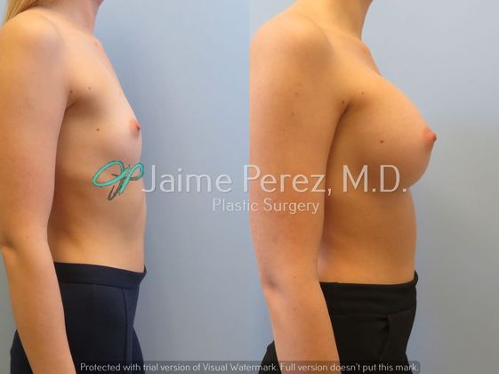 Breast Augmentation: 24 year-old Female: Breast Augmentation - Before & After