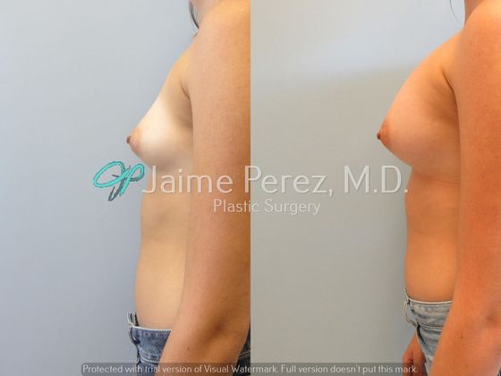 Breast Augmentation: 19 year old: Breast Augmentation - Before & After