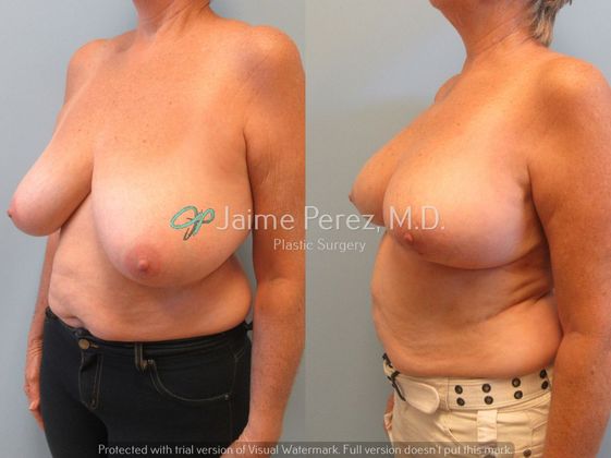 60 year old female Breast Reduction Breast Reduction Before