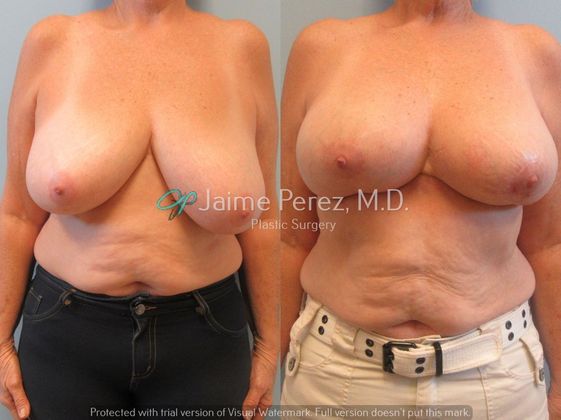 60 year old female Breast Reduction Breast Reduction Before