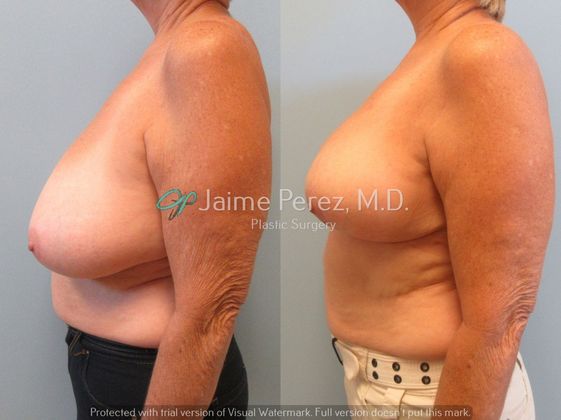 60 year old female Breast Reduction Breast Reduction Before