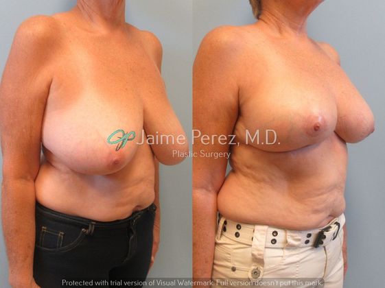 60 year old female Breast Reduction Breast Reduction Before