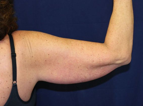 Arm Lift*/Arm Sculpting: Case 1 - Before Back