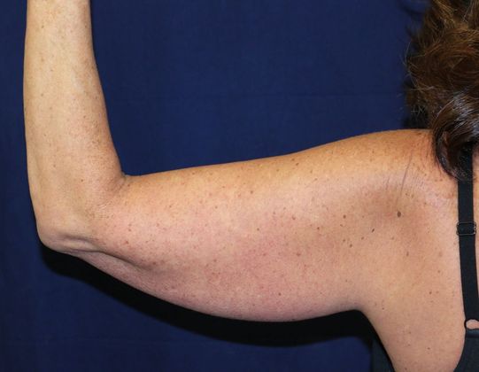 Arm Lift*/Arm Sculpting: Case 1 - Before Back