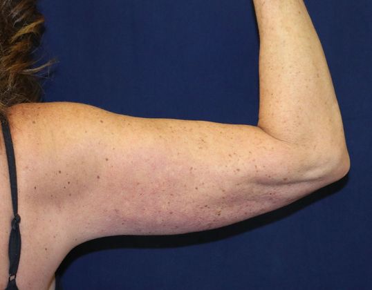 Arm Lift*/Arm Sculpting: Case 1 - After Back