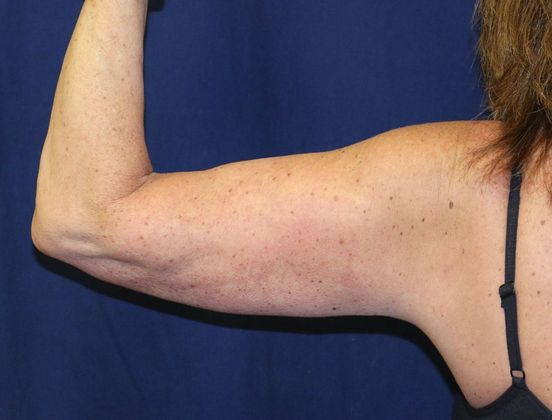 Arm Lift*/Arm Sculpting: Case 1 - After Back