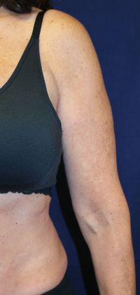 Arm Lift*/Arm Sculpting: Case 1 - Before Front