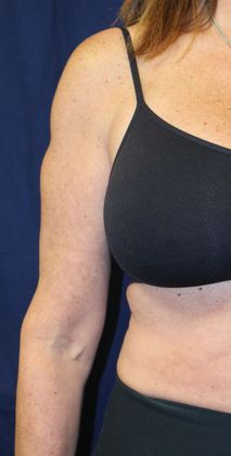 Arm Lift*/Arm Sculpting: Case 1 - After Front