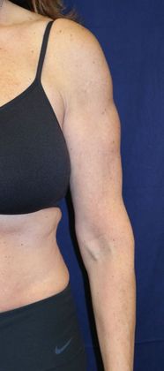 Arm Lift*/Arm Sculpting: Case 1 - After Front