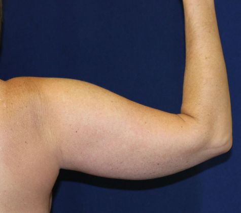 Arm Lift*/Arm Sculpting: Case 2 - Before Back
