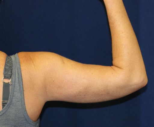 Arm Lift*/Arm Sculpting: Case 2 - After Back
