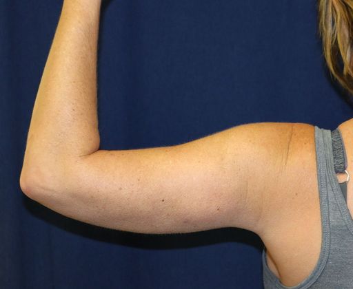 Arm Lift*/Arm Sculpting: Case 2 - After Back