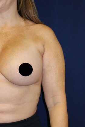 Arm Lift*/Arm Sculpting: Case 2 - Before Front