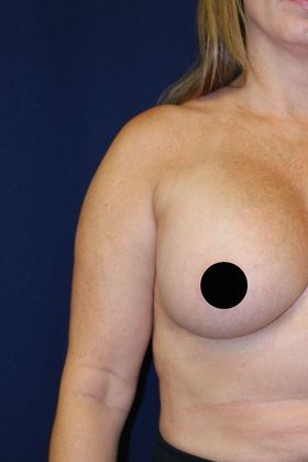 Arm Lift*/Arm Sculpting: Case 2 - Before Front