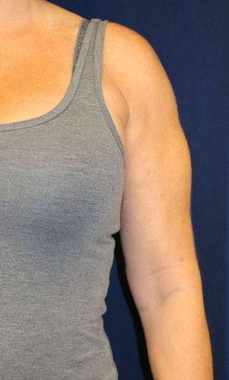Arm Lift*/Arm Sculpting: Case 2 - After Front