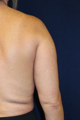 Arm Lift*/Arm Sculpting: Case 2 - Before Back