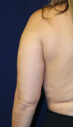 Arm Lift*/Arm Sculpting: Case 2 - Before Back