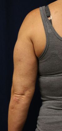 Arm Lift*/Arm Sculpting: Case 2 - After Back