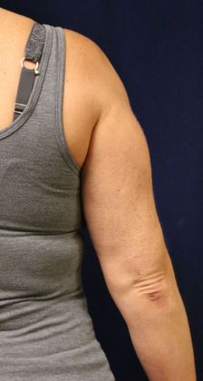 Arm Lift*/Arm Sculpting: Case 2 - After Back