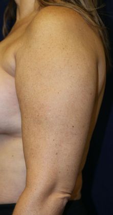 Arm Lift*/Arm Sculpting: Case 2 - Before Left