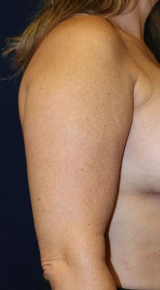Arm Lift*/Arm Sculpting: Case 2 - Before Right