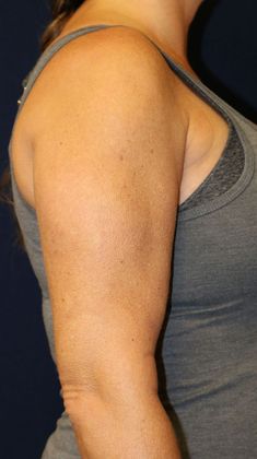 Arm Lift*/Arm Sculpting: Case 2 - After Right