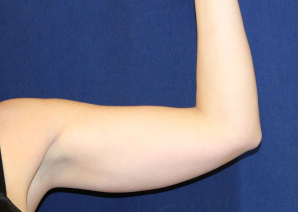 Arm Lift*/Arm Sculpting: Case 4 - Before 