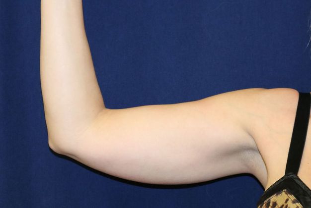 Arm Lift*/Arm Sculpting: Case 4 - Before 