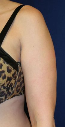 Arm Lift*/Arm Sculpting: Case 4 - Before 