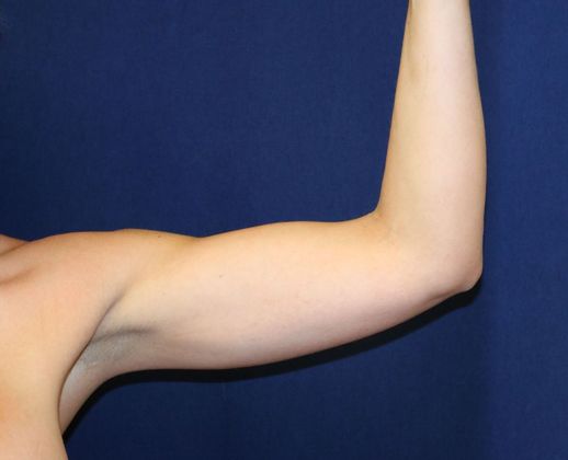 Arm Lift*/Arm Sculpting: Case 4 - After