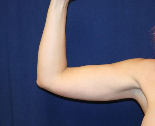 Arm Sculpting Reno Lake Tahoe Arm Liftarm Sculpting Before And