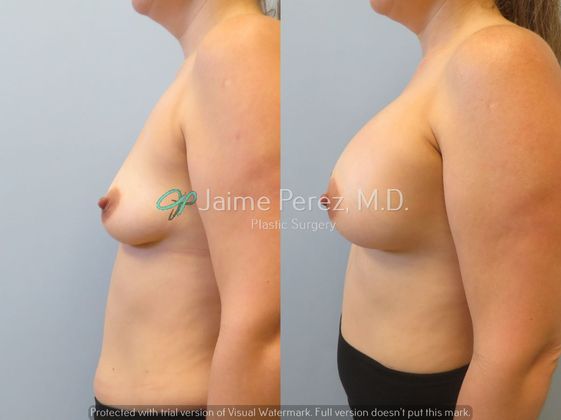 Breast Augmentation: 36 year-old Female: Breast Augmenation with Silicone Implants - Before & After