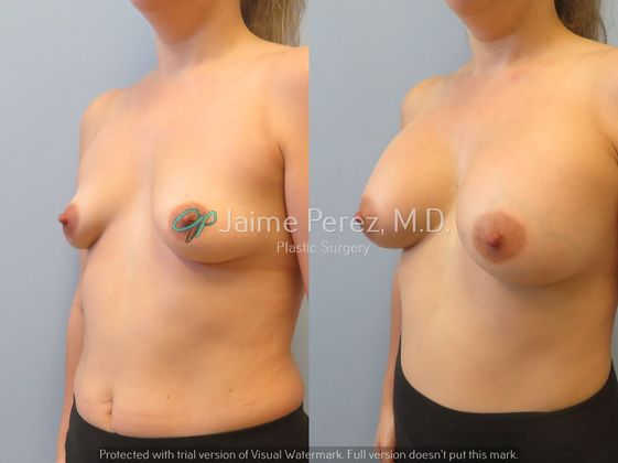 Breast Augmentation: 36 year-old Female: Breast Augmenation with Silicone Implants - Before & After