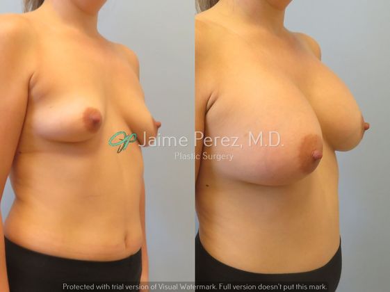 Breast Augmentation: 36 year-old Female: Breast Augmenation with Silicone Implants - Before & After