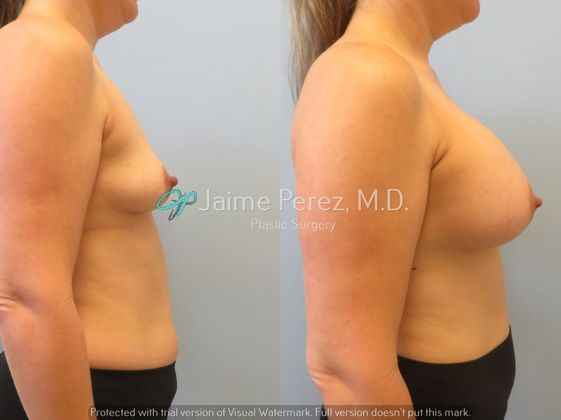 Breast Augmentation: 36 year-old Female: Breast Augmenation with Silicone Implants - Before & After
