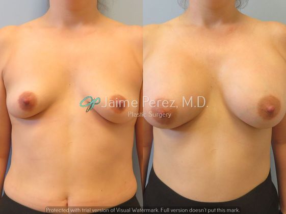 Breast Augmentation: 36 year-old Female: Breast Augmenation with Silicone Implants - Before & After