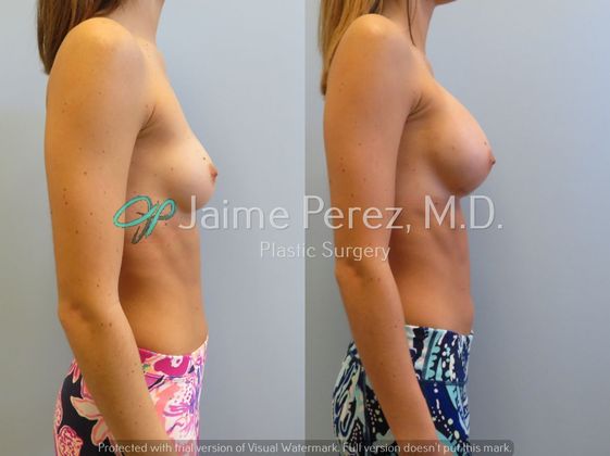 Breast Augmentation: 24-year-old Female: Breast Augmentation - Before & After