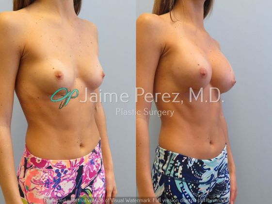 Breast Augmentation: 24-year-old Female: Breast Augmentation - Before & After