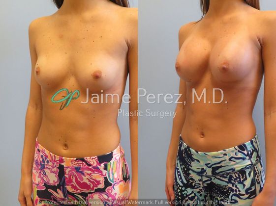Breast Augmentation: 24-year-old Female: Breast Augmentation - Before & After