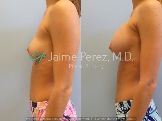 Breast Augmentation: 24-year-old Female: Breast Augmentation - Before & After