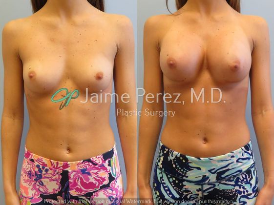 Breast Augmentation: 24-year-old Female: Breast Augmentation - Before & After