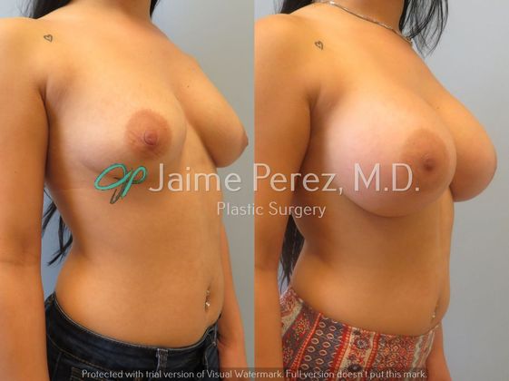 Breast Augmentation: 23-year-old Female: Breast Augmentation with 400cc Silicone Implants - Before & After