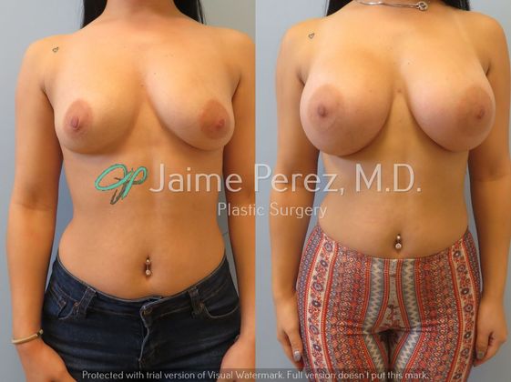 Breast Augmentation: 23-year-old Female: Breast Augmentation with 400cc Silicone Implants - Before & After