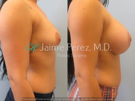 Breast Augmentation: 23-year-old Female: Breast Augmentation with 400cc Silicone Implants - Before & After