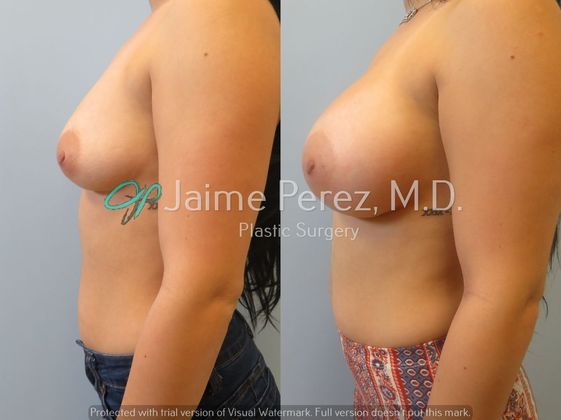 Breast Augmentation: 23-year-old Female: Breast Augmentation with 400cc Silicone Implants - Before & After
