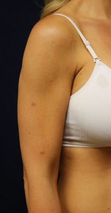 Arm Lift*/Arm Sculpting: Case 6 - After Front