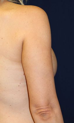 Arm Lift*/Arm Sculpting: Case 6 - Before Back