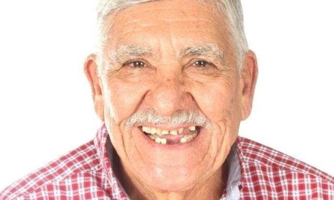 All on 4 Dental Implants Case 8 - Before