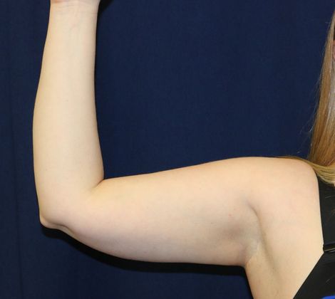 Arm Lift*/Arm Sculpting: Case 5 - Before Front